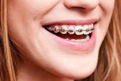 How Braces Improve More Than Just Your Smile