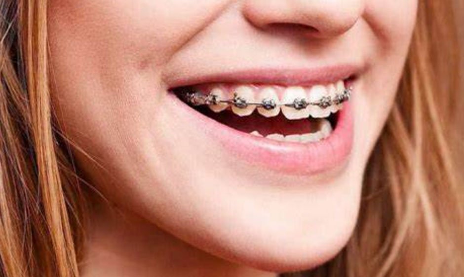 How Braces Improve More Than Just Your Smile