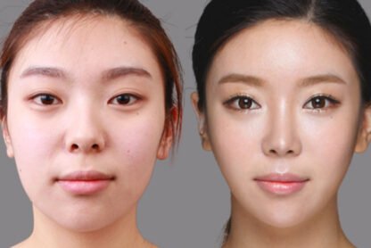 How Finding the Best Cosmetic Surgeon Enhances Your Asian Eye Lift Results