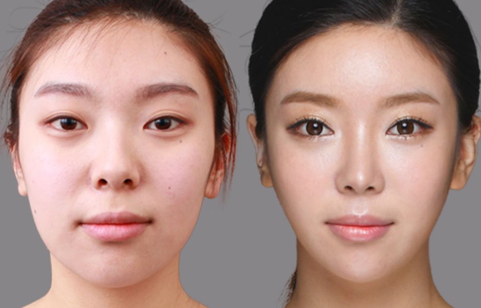 How Finding the Best Cosmetic Surgeon Enhances Your Asian Eye Lift Results